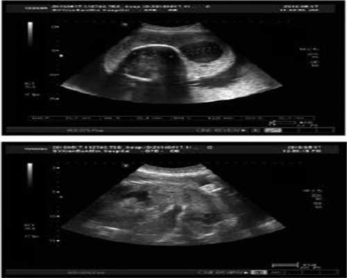 6个月脐带扭转导致胎停，是什么原因下次怀孕需