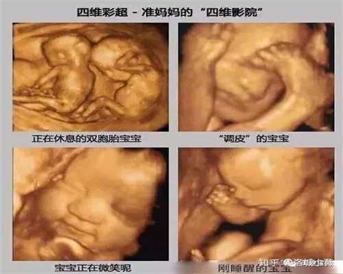 怀孕50天无胎心，检查子宫里都是“小蝌蚪”！医
