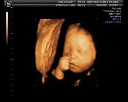 怀孕50天无胎心，检查子宫里都是“小蝌蚪”！医