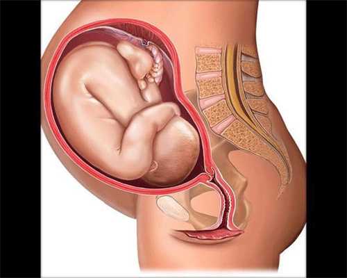 做试管婴儿短方案：怀胎32周孕妇被迫剖腹产，急